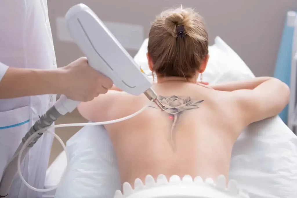 What to Expect During and After Laser Tattoo Removal? 2 laser tattoo removal by instinctbozeman in bozeman