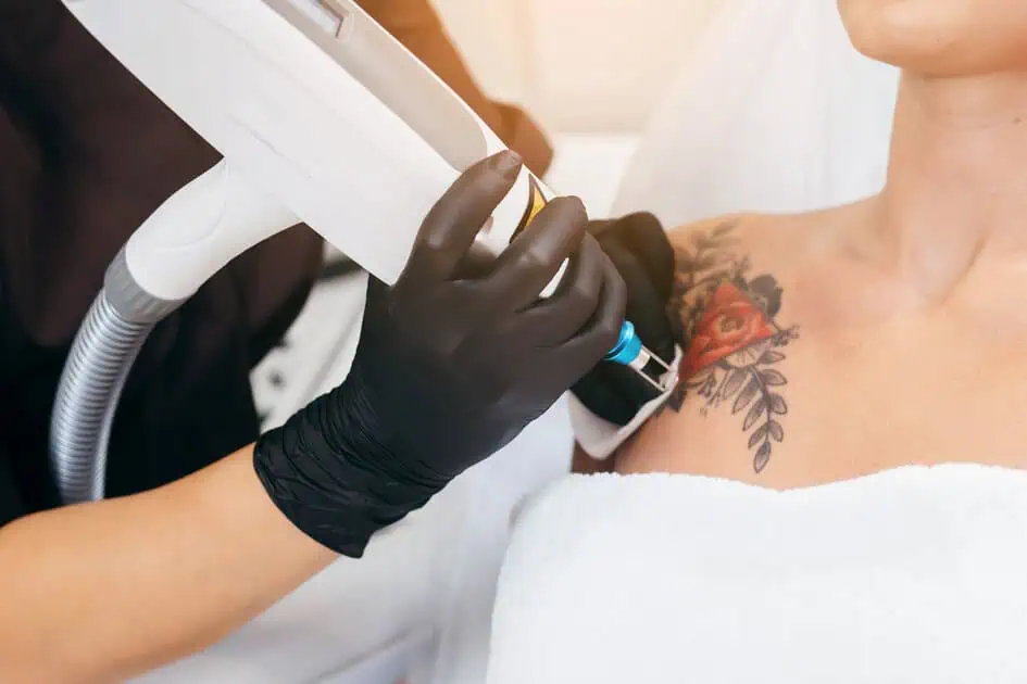 Is Laser Tattoo Removal Painful? Here's What You Should Know 1 Laser Tattoo Removal by Instinct Holistic Medical Spa in BOZEMAN, MT