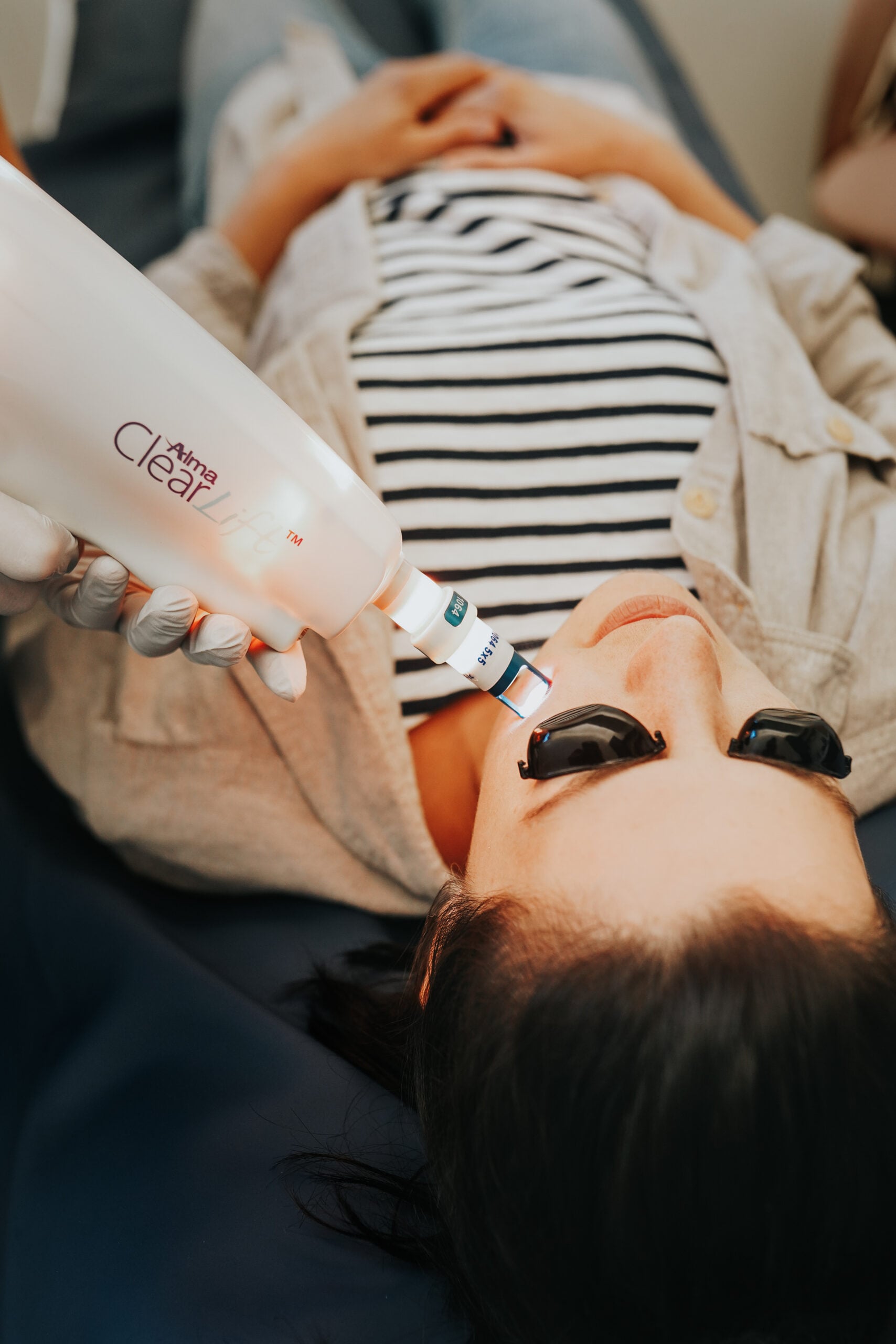 IPL Photofacial Benefits