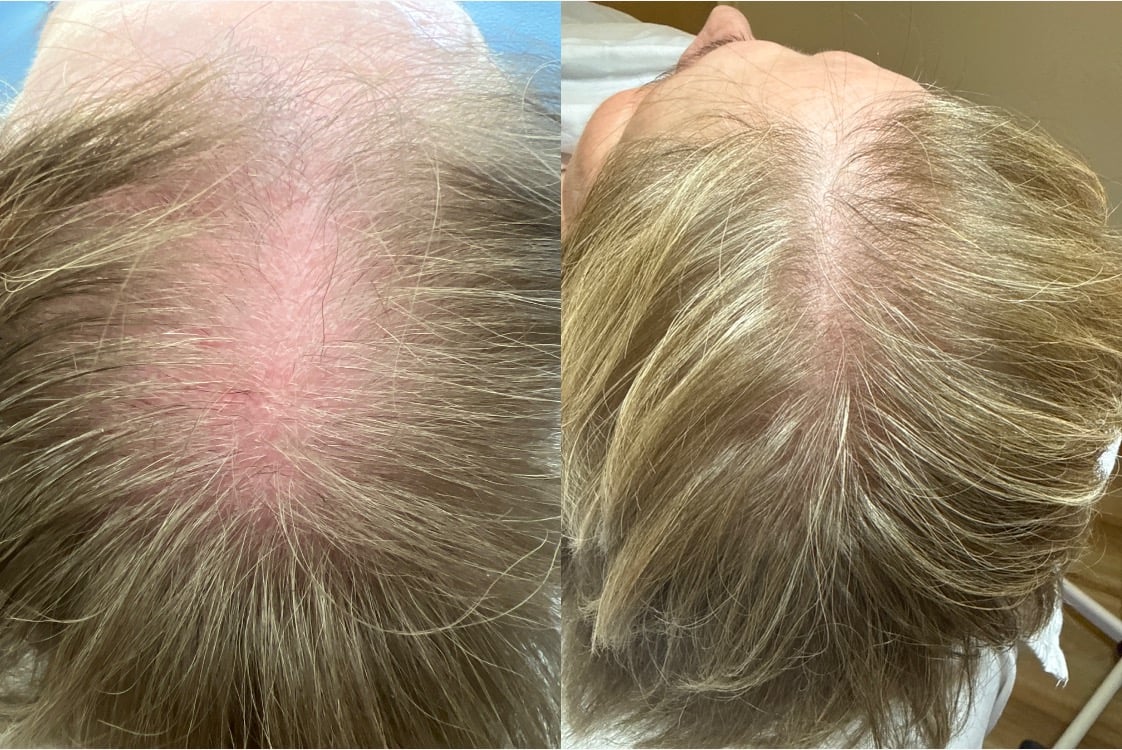 HAIR RESTORATION IN BOZEMAN, MT 1 Before and after photos of a client’s crown, showing fuller hair after a series of FoLix laser and Keravive scalp treatments at Instinct in Bozeman